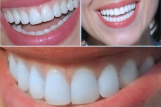 Diş Kaplama Çeşitleri Nelerdir?