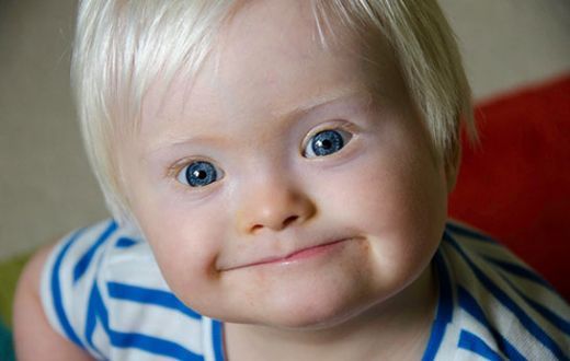 Sendrom Çeşitleri Nelerdir?